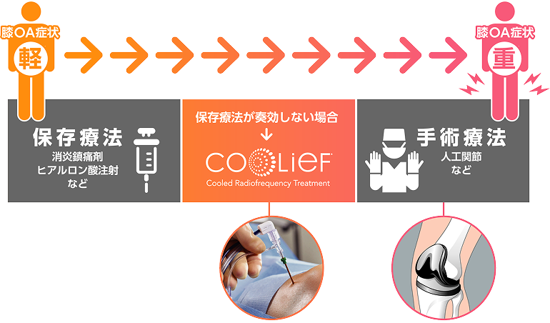 膝OA症状→脱OA症状 保存療法：消炎鎮痛剤 ヒアルロン酸注射など 保存療法が奏功しない場合→Cooled Radiofrequency Treatment 手術療法：人工関節など
